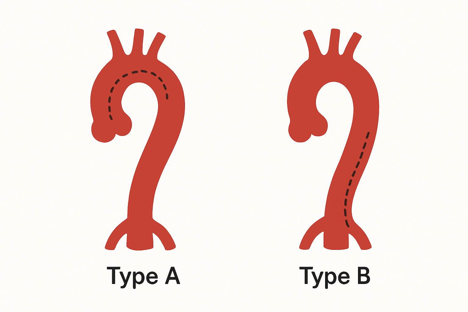 Diagram contrasting type A ascending-aortic involvement with type B, which spares the ascending aorta; type A can extend distally and type B may still become complicated.