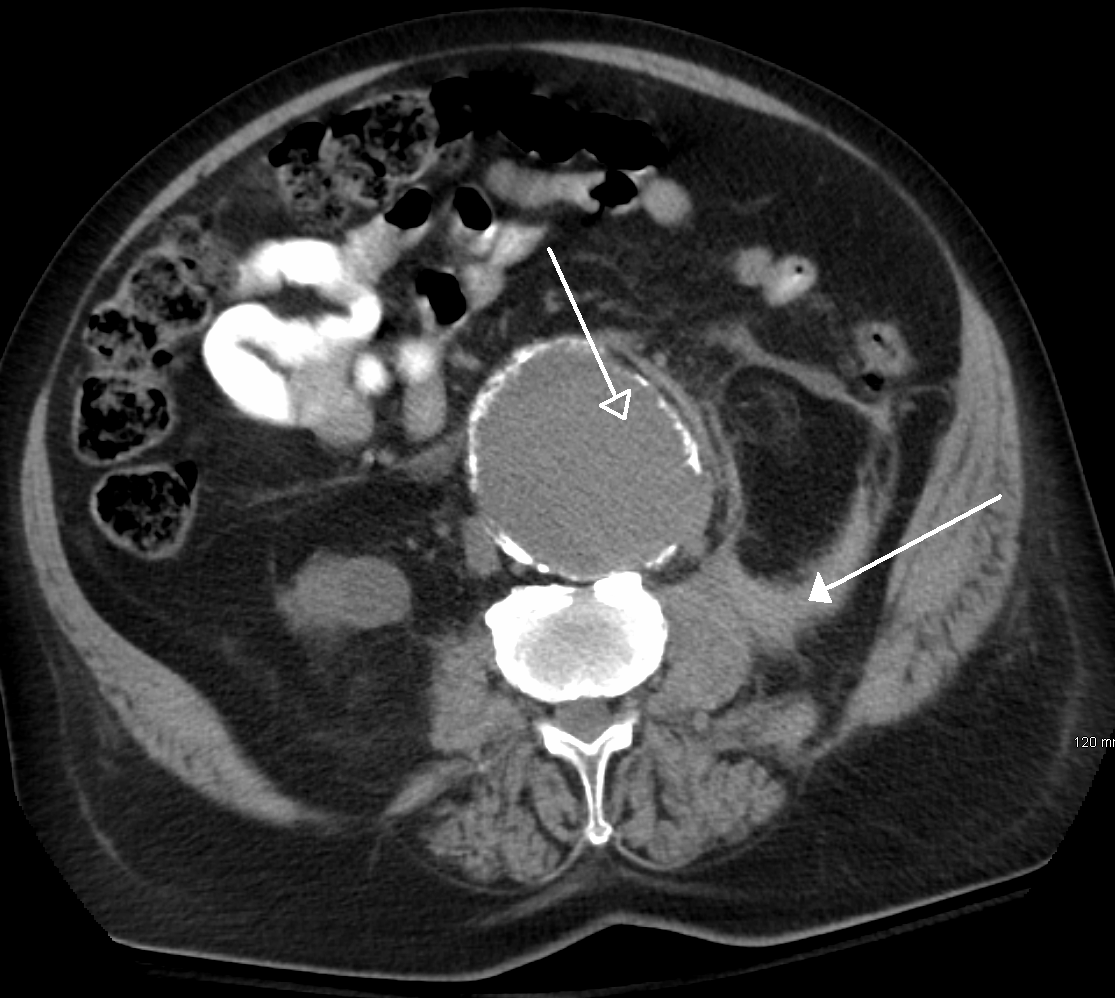 Axial CT showing a large calcified abdominal aortic aneurysm with adjacent retroperitoneal haemorrhage (arrows).