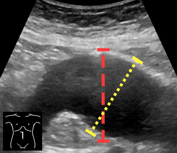 Abdominal ultrasound measuring the maximal anteroposterior aortic diameter, the modality used by the national AAA screening programme.