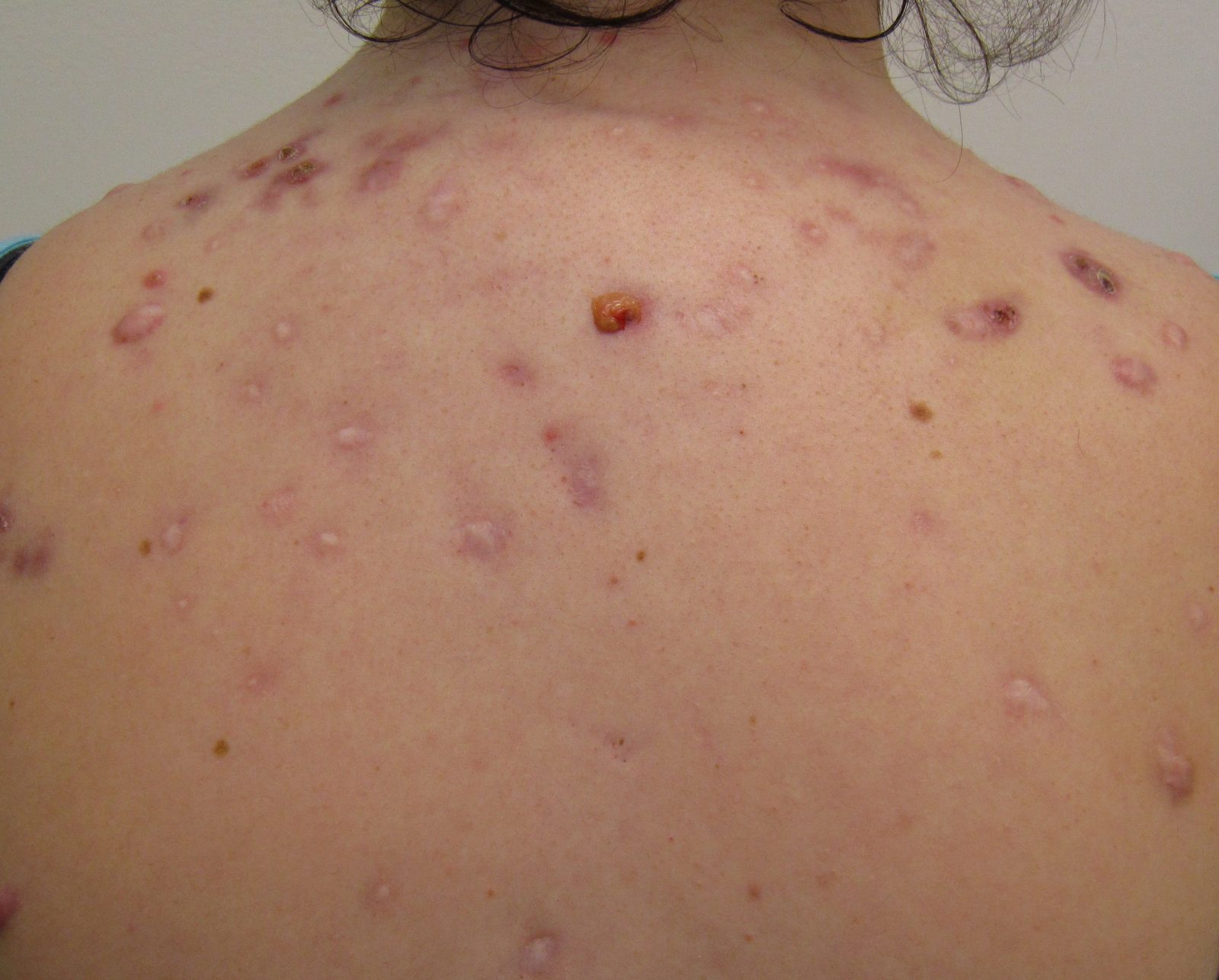 Clinical photograph of deep inflammatory nodules and established scarring, showing why duration and depth of inflammation justify early specialist referral.