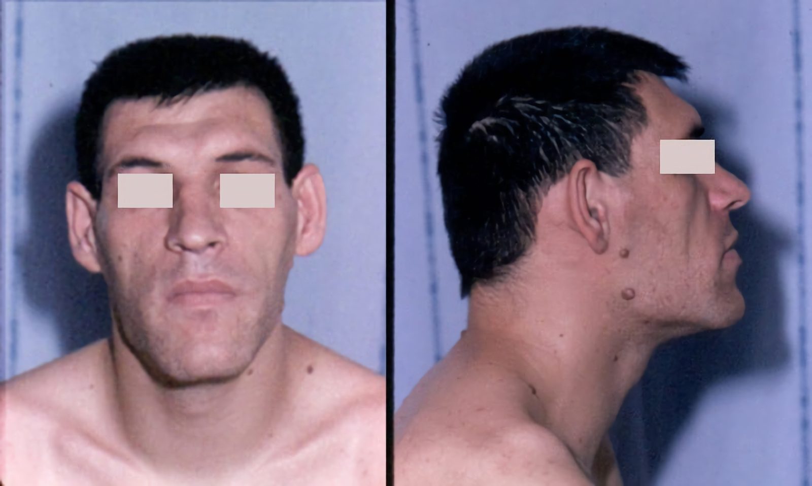 A clinical illustration of the acromegalic face: frontal bossing, prognathism, coarse features and prominent supraorbital ridges, ideally shown as a change over years.