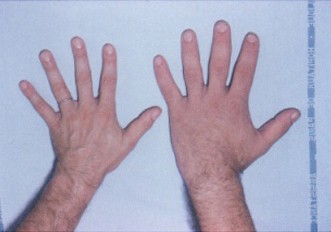 Comparison photograph showing the broad, enlarged hand and thick fingers characteristic of acromegaly.
