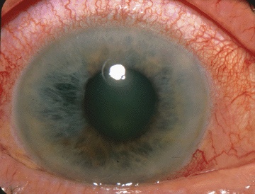 Acute angle-closure glaucoma showing a cloudy cornea and a fixed, mid-dilated pupil.
