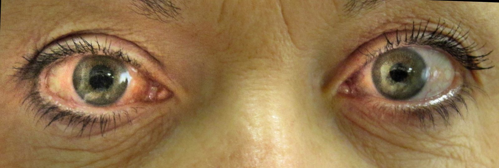 Clinical photograph of a painful red eye caused by acute angle-closure glaucoma.