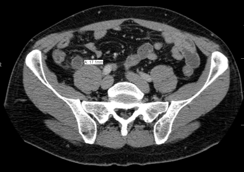 Axial contrast CT image showing a dilated, thick-walled appendix with surrounding fat stranding and a possible appendicolith; image is for recognition and does not replace clinical assessment.