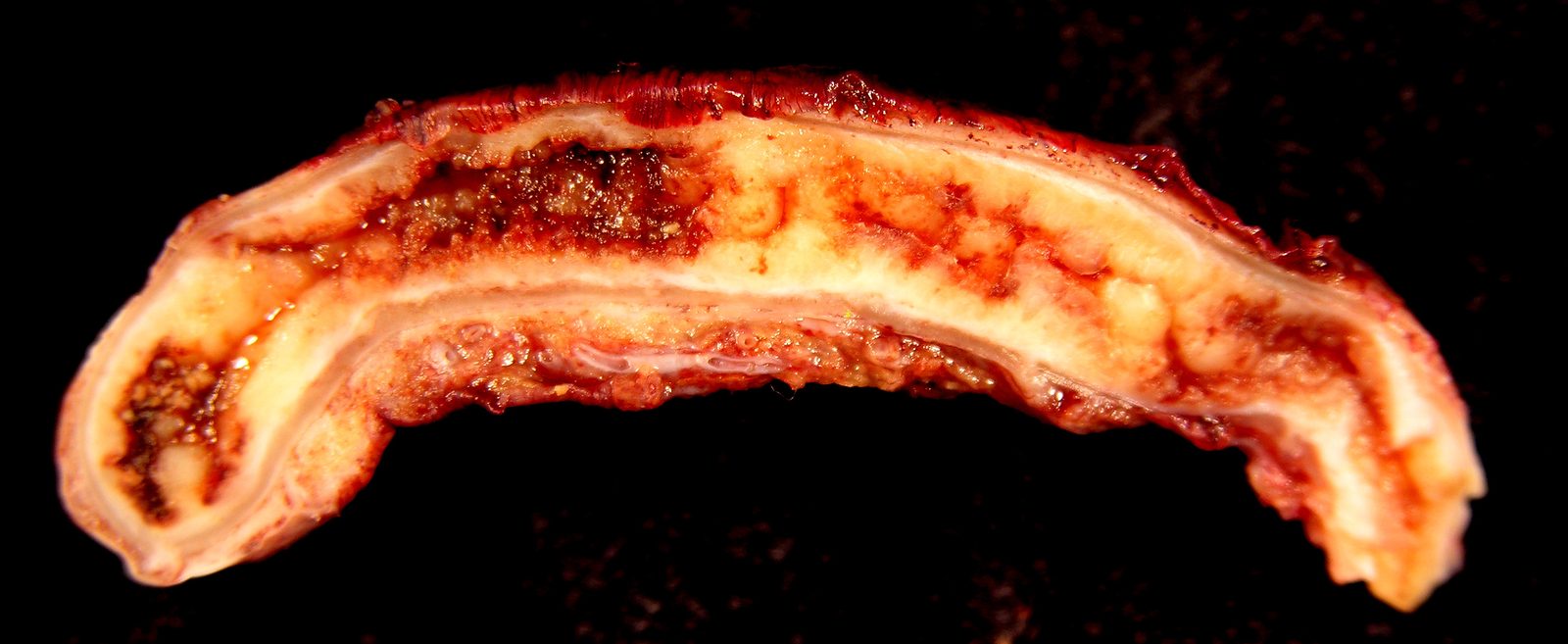 Resected inflamed appendix with an exudate-covered serosal surface, illustrating the macroscopic correlate of transmural inflammation.