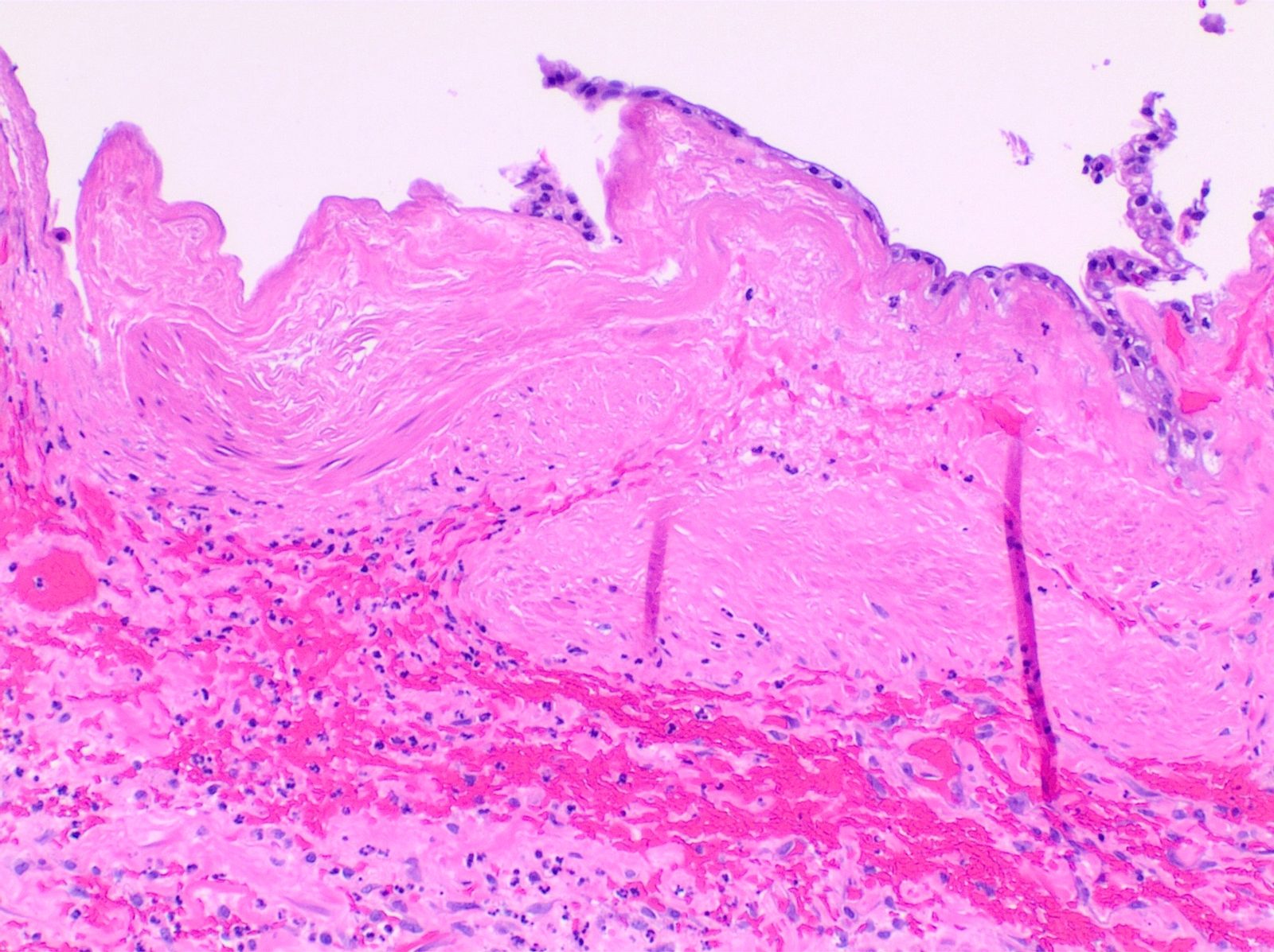 Histological section of gallbladder wall showing sloughed mucosa, necrosis and dense neutrophilic inflammation in gangrenous acute cholecystitis.
