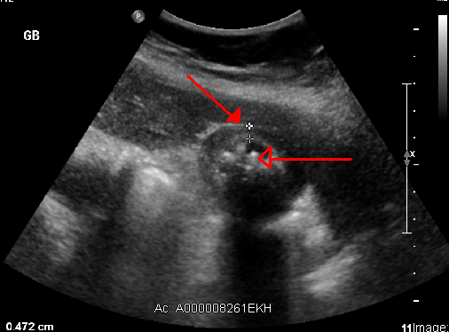 Gallbladder ultrasound demonstrating abnormal wall thickening, highlighted by arrows and calipers.