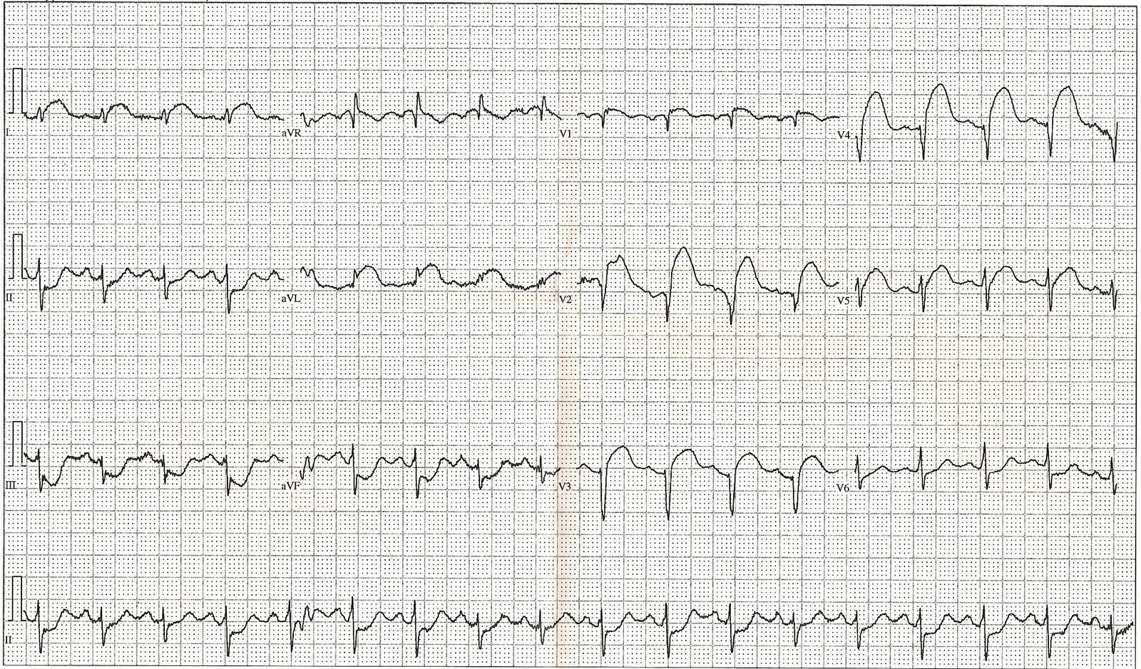 Twelve-lead ECG showing regional ST-segment elevation with reciprocal ST depression. In a compatible acute ischaemic presentation this pattern supports a working diagnosis of STEMI and immediate reperfusion assessment, but the tracing must be interpreted in its clinical context.