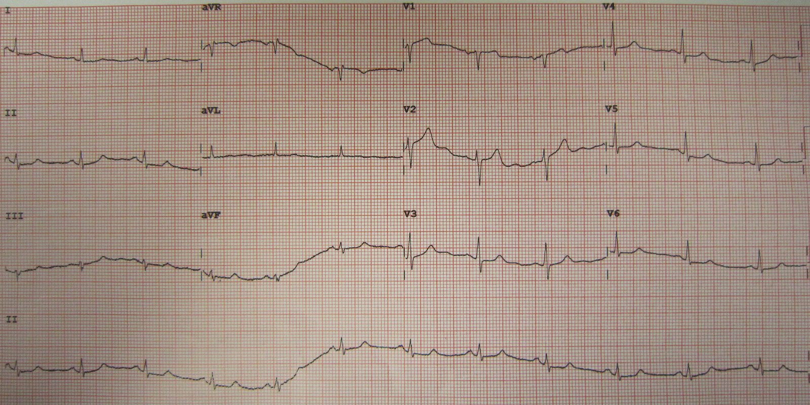 Twelve-lead ECG showing a Wellens T-wave pattern, which warns of critical proximal left anterior descending coronary disease and needs urgent specialist assessment. It is a high-risk non-ST-elevation acute coronary syndrome pattern, not a generic diagnostic tracing for NSTEMI.