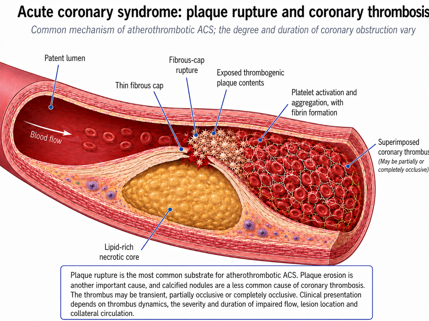 Diagram of an atherosclerotic plaque with cap disruption, platelet activation and thrombus in the coronary lumen. This is a common type 1 ACS mechanism, not a diagram that determines the presenting ECG label or proves the degree of occlusion.
