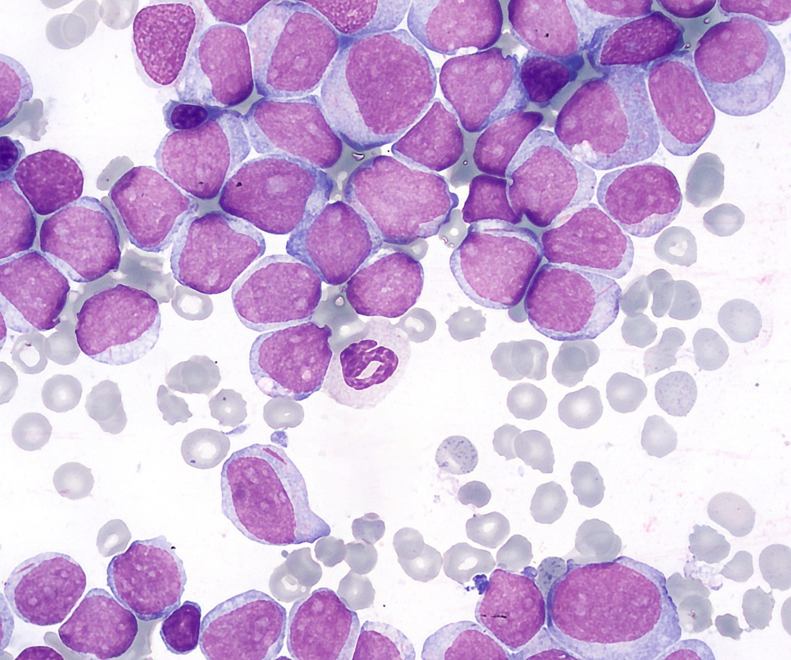 Peripheral blood film in acute myeloid leukaemia showing myeloblasts, one containing a needle-shaped Auer rod.