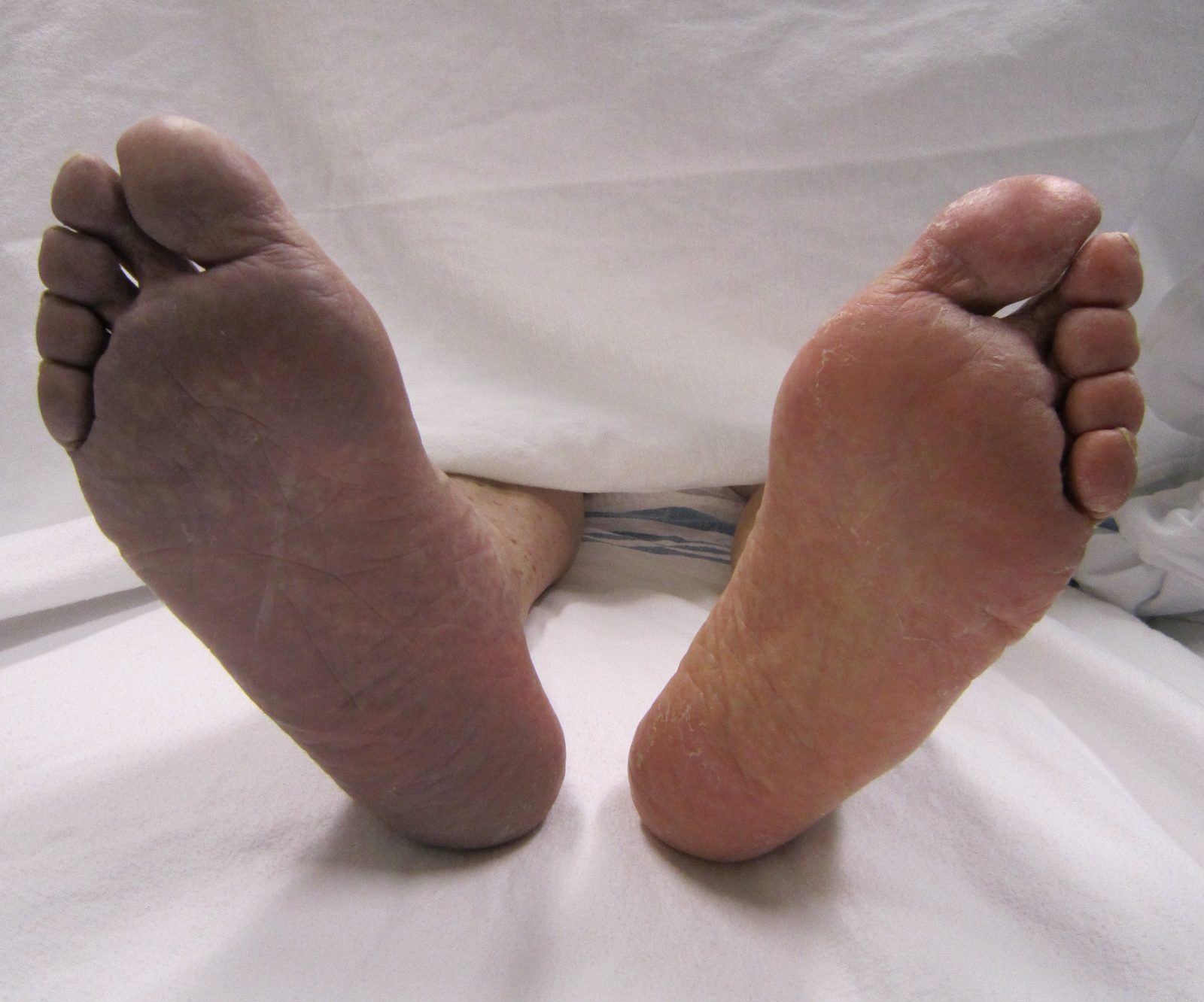 Marked unilateral plantar cyanosis caused by acute arterial thrombosis, contrasted with the normally perfused opposite foot.