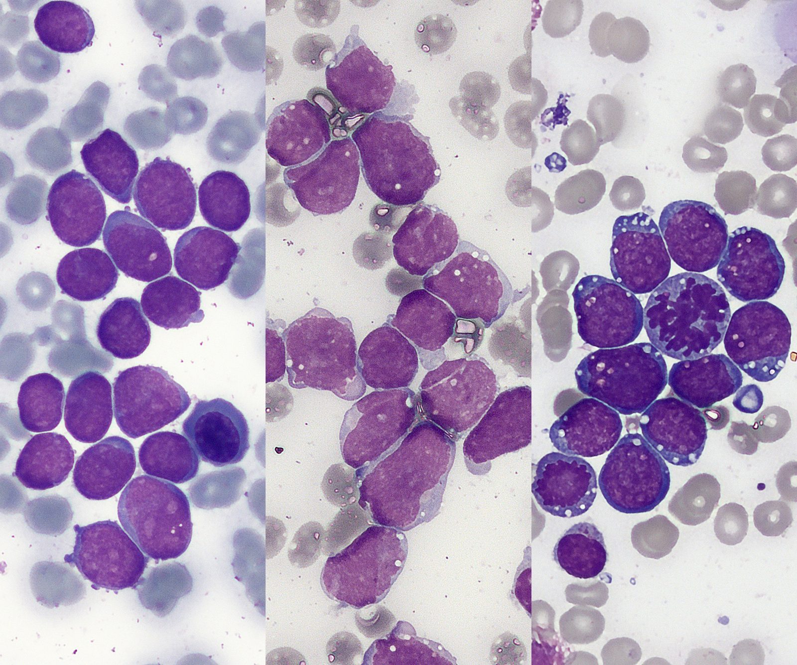 Peripheral blood film showing lymphoblasts with a high nuclear-to-cytoplasmic ratio and no Auer rods.