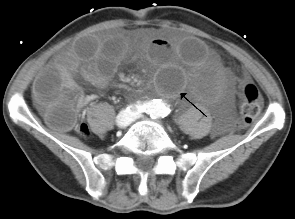 Axial contrast CT showing multiple dilated fluid-filled small-bowel loops with wall thickening, an imaging appearance of acute mesenteric ischaemia.