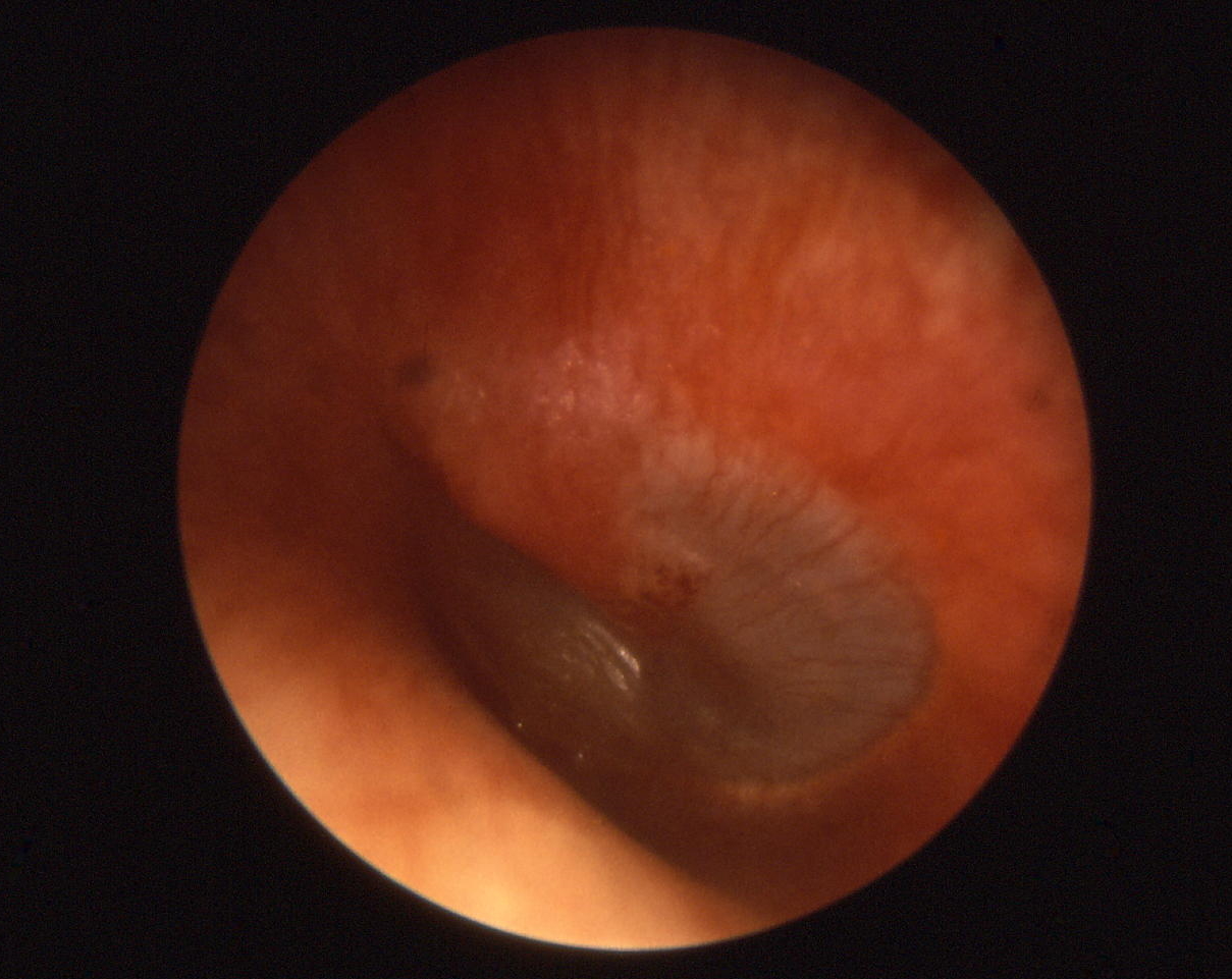 Otoscopic view in acute otitis media showing an inflamed, bulging tympanic membrane with loss of normal landmarks and light reflex; bulging is the key sign distinguishing acute otitis media from uncomplicated effusion.