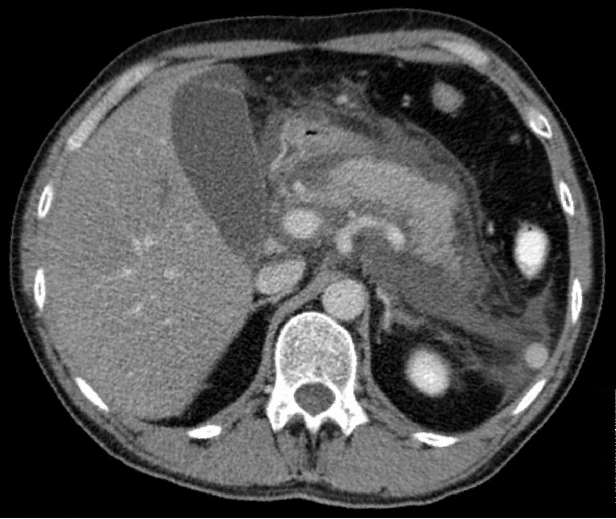 Axial CT showing an enlarged oedematous pancreas with surrounding inflammatory change and peripancreatic fluid.