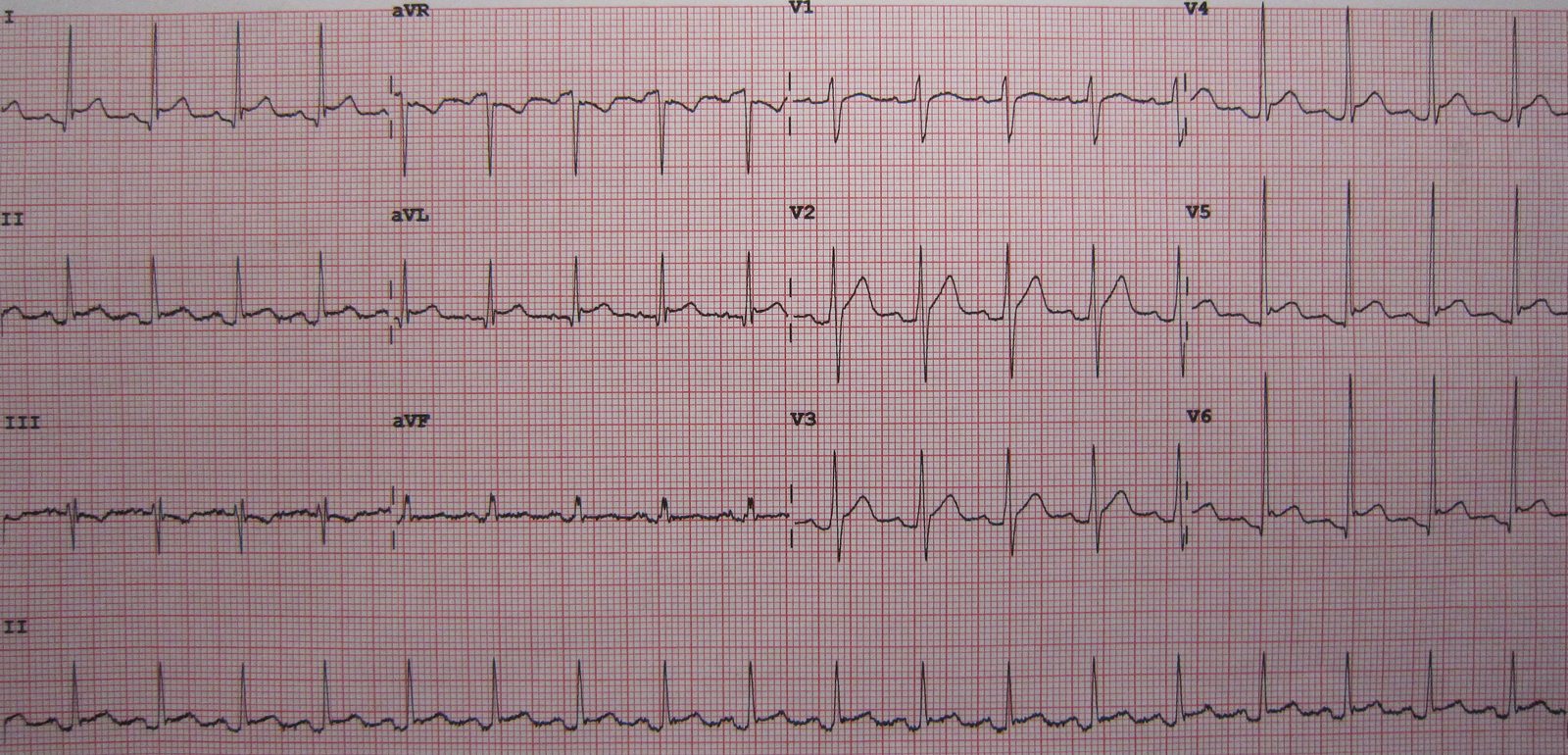 12-lead ECG showing widespread concave ST-segment elevation and PR depression across multiple leads, with a caution that acute coronary syndromes can overlap and require clinical correlation.