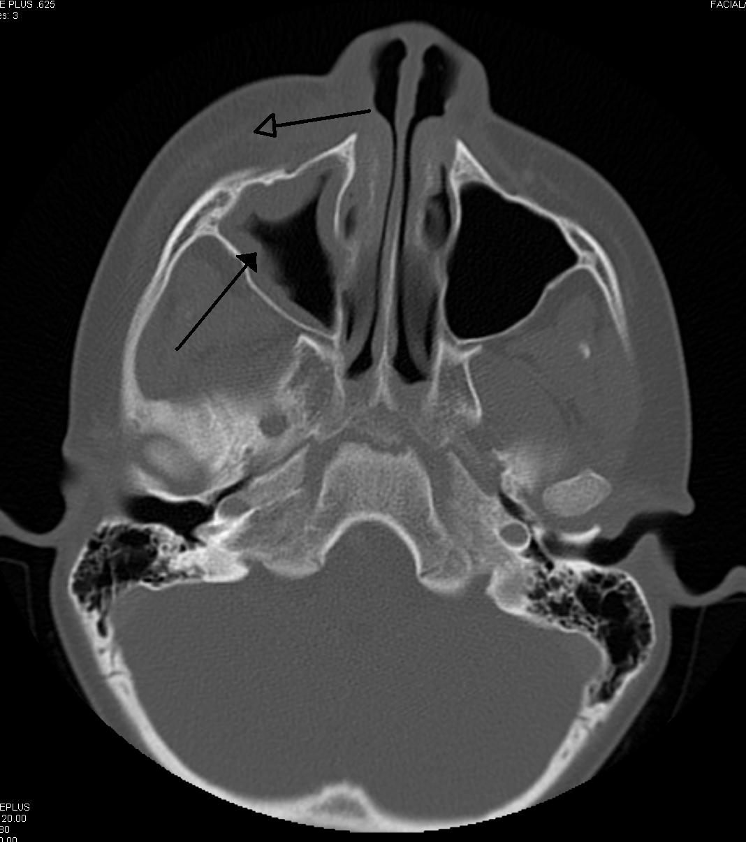 Axial CT showing right maxillary sinusitis and adjacent orbital inflammatory swelling, highlighted by arrows.