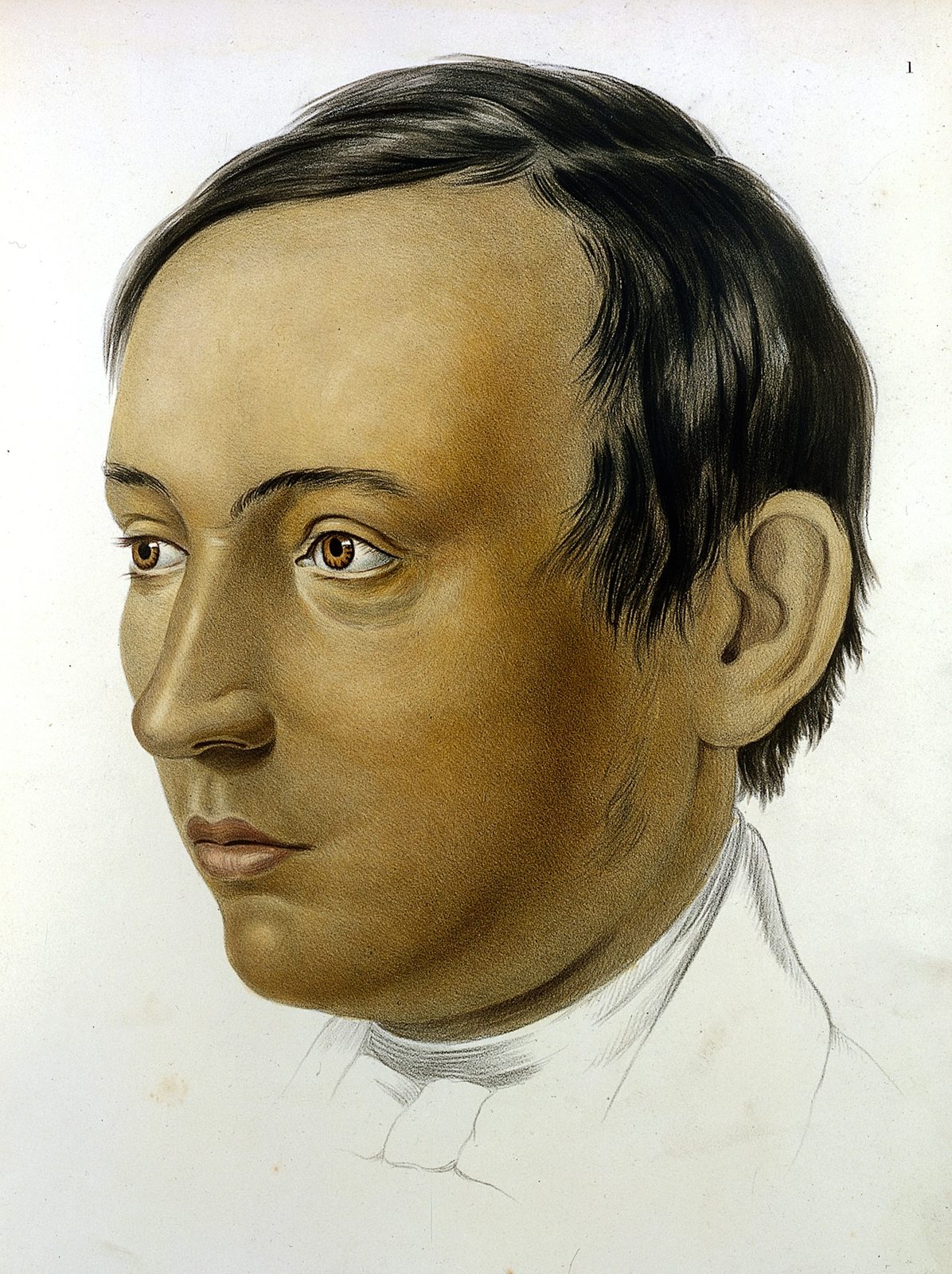 Historical clinical illustration showing the diffuse bronze facial pigmentation associated with primary adrenal insufficiency.