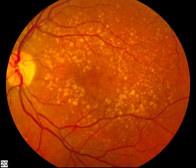 Colour fundus photograph showing numerous yellow drusen clustered around the macula, a feature of dry age-related macular degeneration. The image should be labelled as a visual example rather than a substitute for slit-lamp examination or OCT.