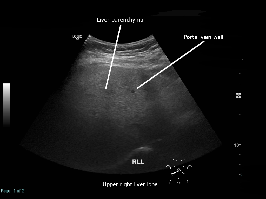 Abdominal ultrasound showing a diffusely bright, echogenic liver consistent with fatty infiltration.