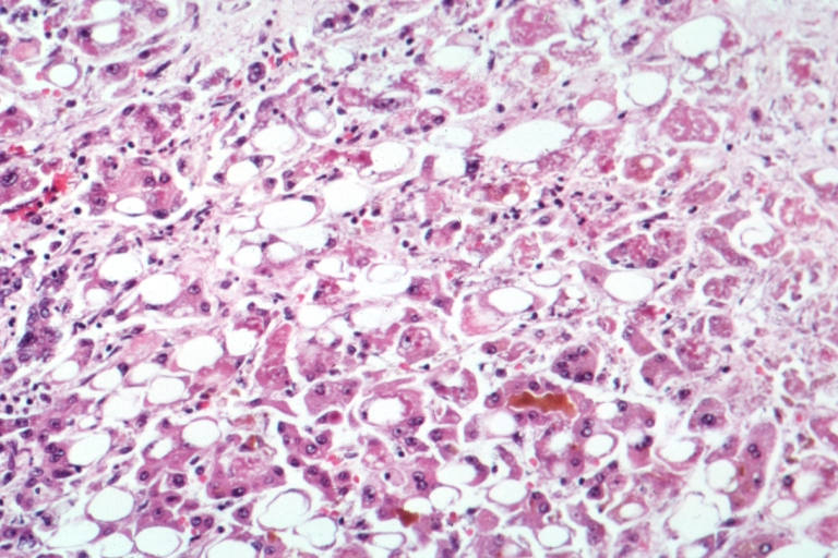 Liver biopsy showing fatty change, ballooned hepatocytes, inflammation and Mallory-Denk-type eosinophilic material in alcohol-related steatohepatitis.