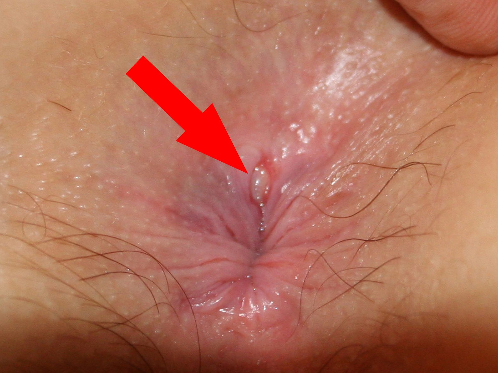 Clinical photograph of a longitudinal anoderm tear at the posterior midline with an associated distal skin tag characteristic of a chronic fissure.