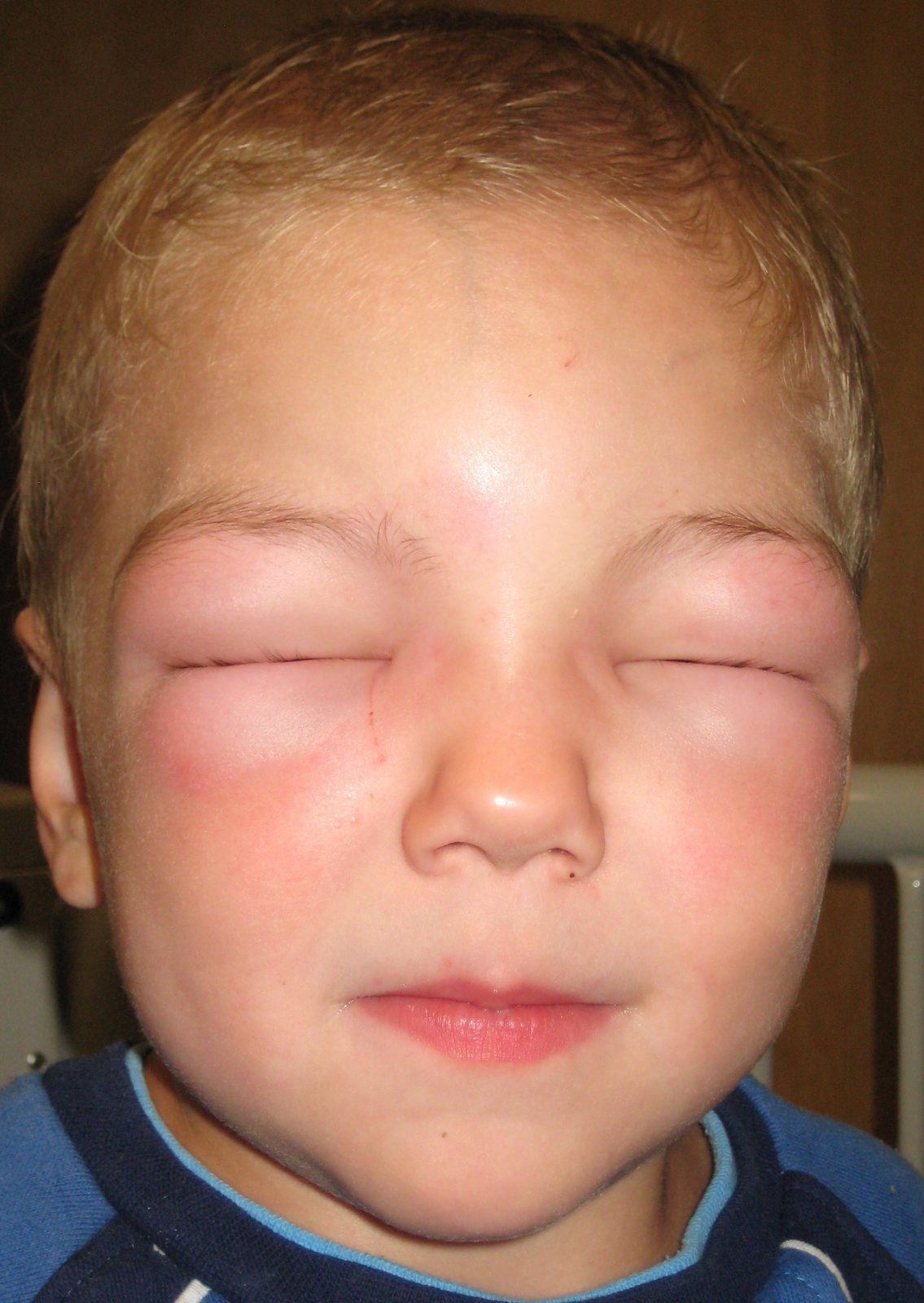 A patient photograph showing periorbital angioedema, a mucosal feature that may accompany anaphylaxis but does not by itself define it.