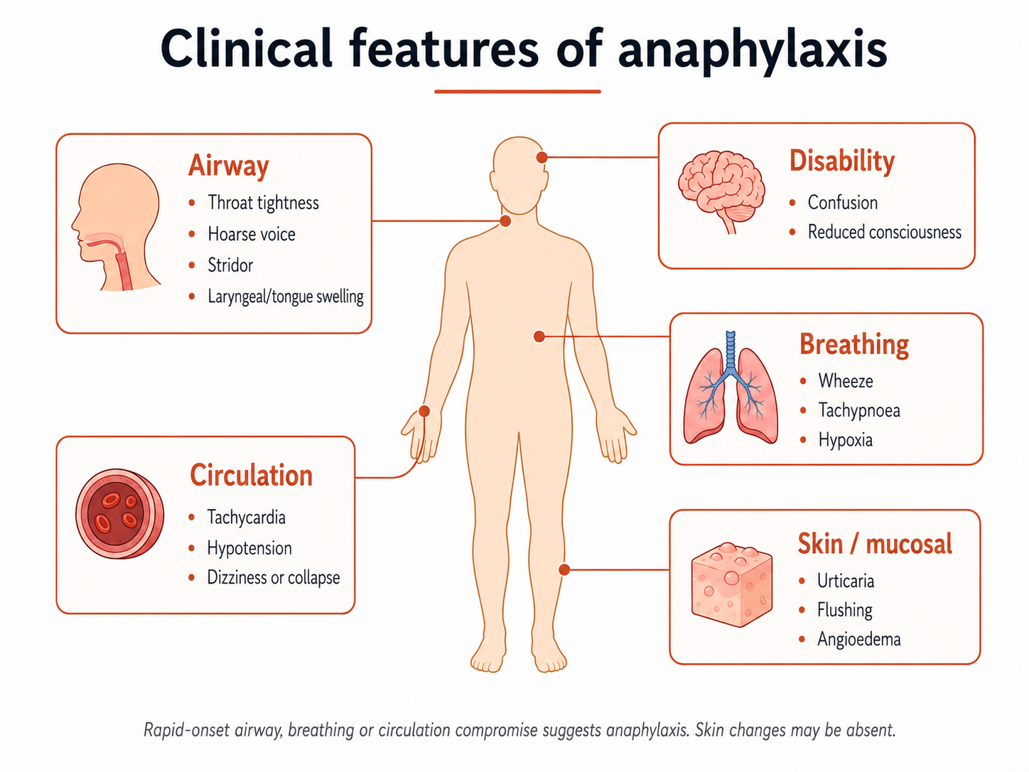 A body map of anaphylaxis by system: airway, breathing, circulation, disability and skin or mucosal changes. Skin findings can be subtle or absent in 10 to 20% of reactions; airway, breathing or circulation compromise defines the emergency.