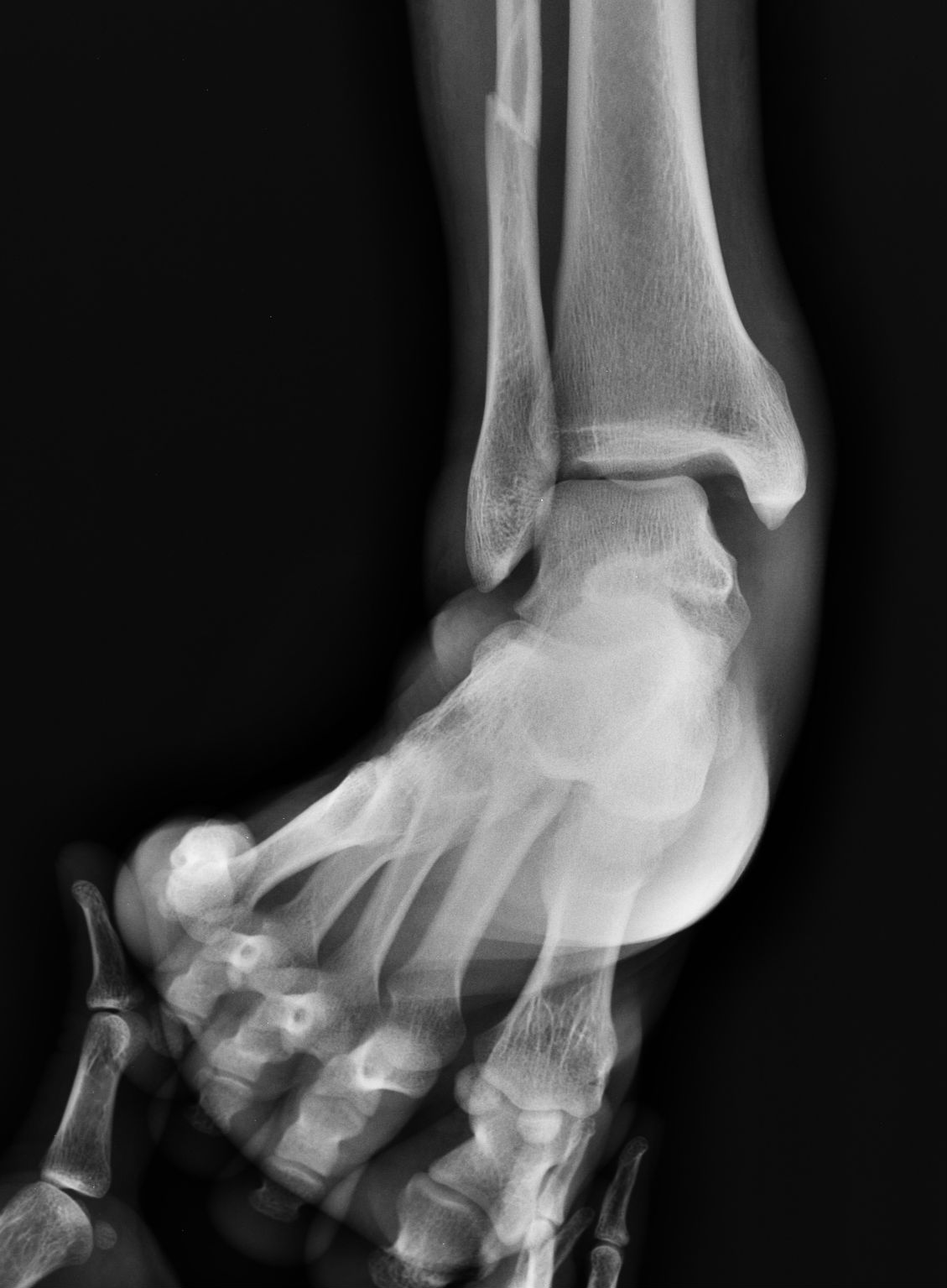 Stress radiograph demonstrating a distal fibular fracture with medial clear-space widening and lateral talar shift, indicating an unstable ankle mortise.