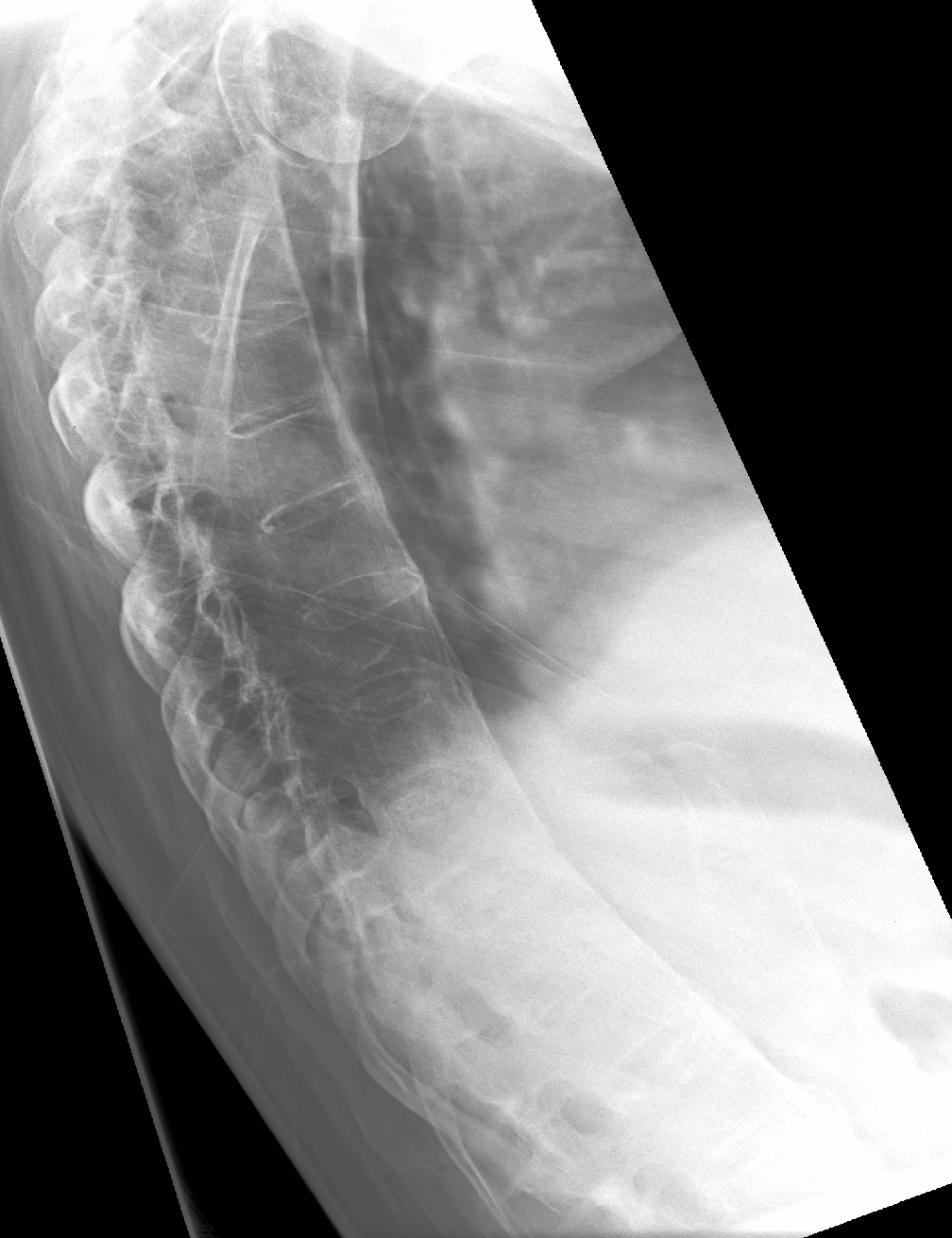 Lateral thoracic spine radiograph showing marginal syndesmophytes bridging multiple vertebral bodies to create the bamboo-spine appearance of advanced ankylosing spondylitis.