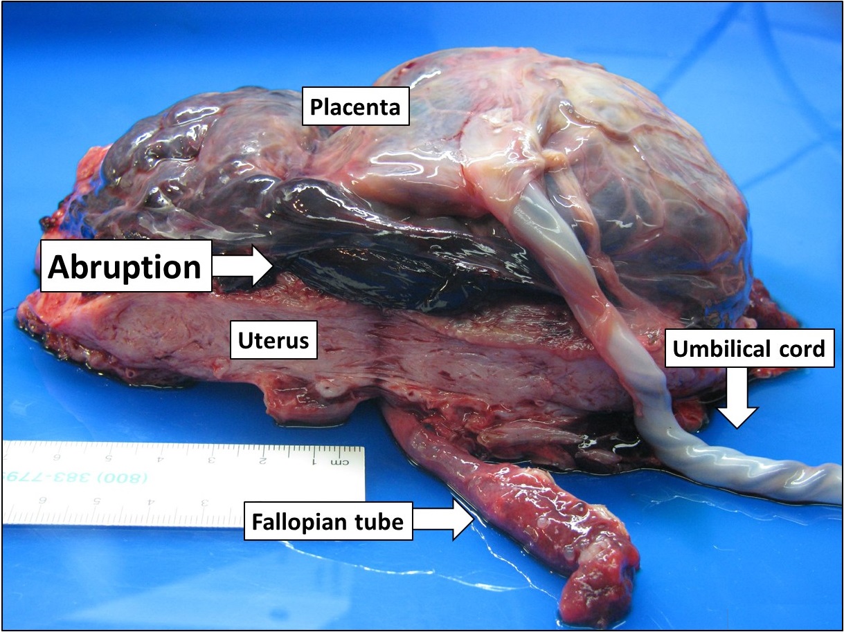 Gross pathology specimen of a delivered placenta with an adherent retroplacental haematoma indenting and separating the maternal surface.