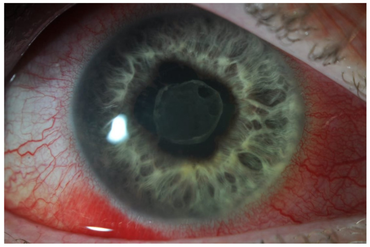 Slit-lamp clinical photograph showing circumcorneal ciliary injection around the limbus in acute anterior uveitis.