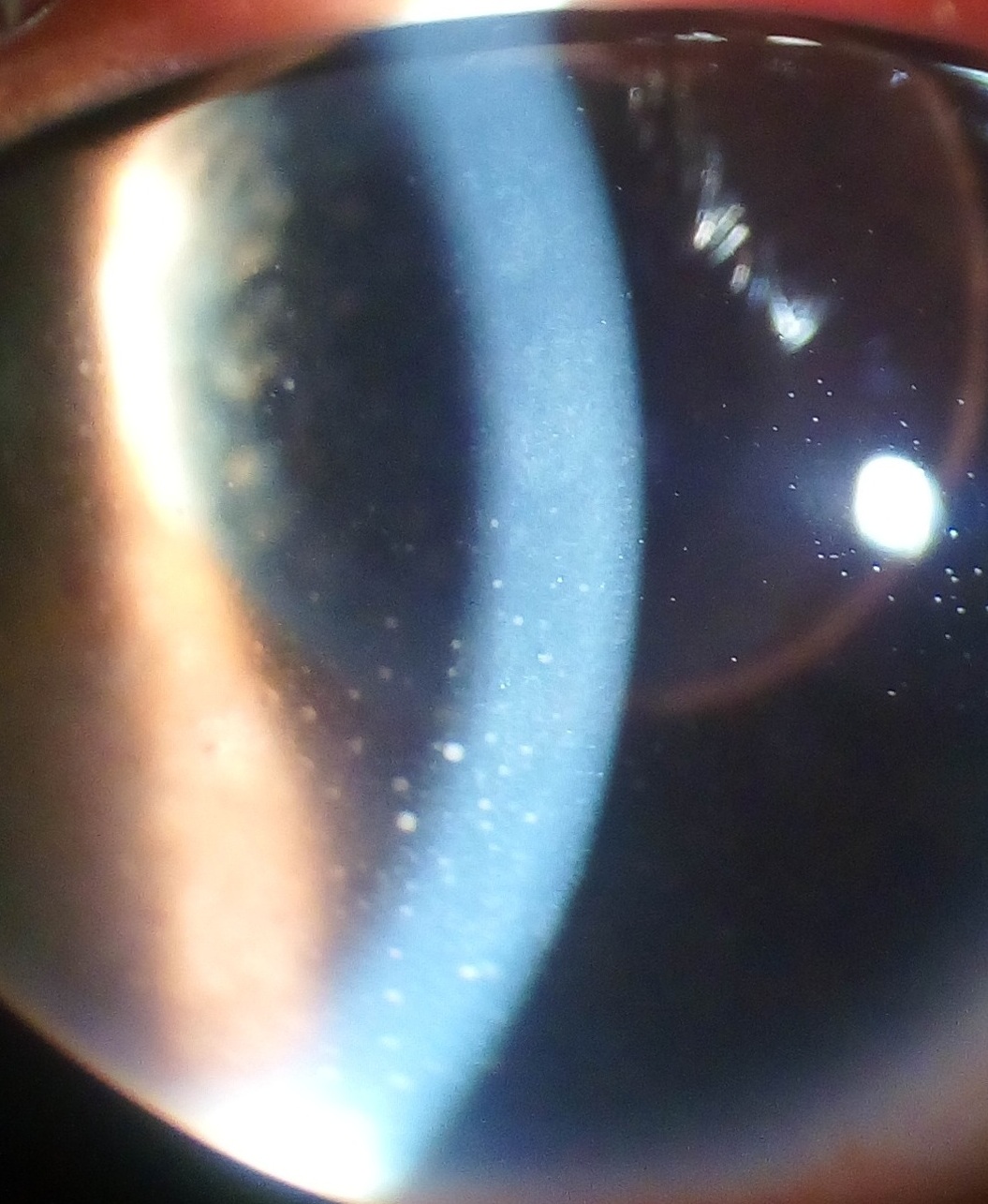 Slit-lamp photograph showing fine keratic precipitates deposited on the inferior corneal endothelium in anterior uveitis.