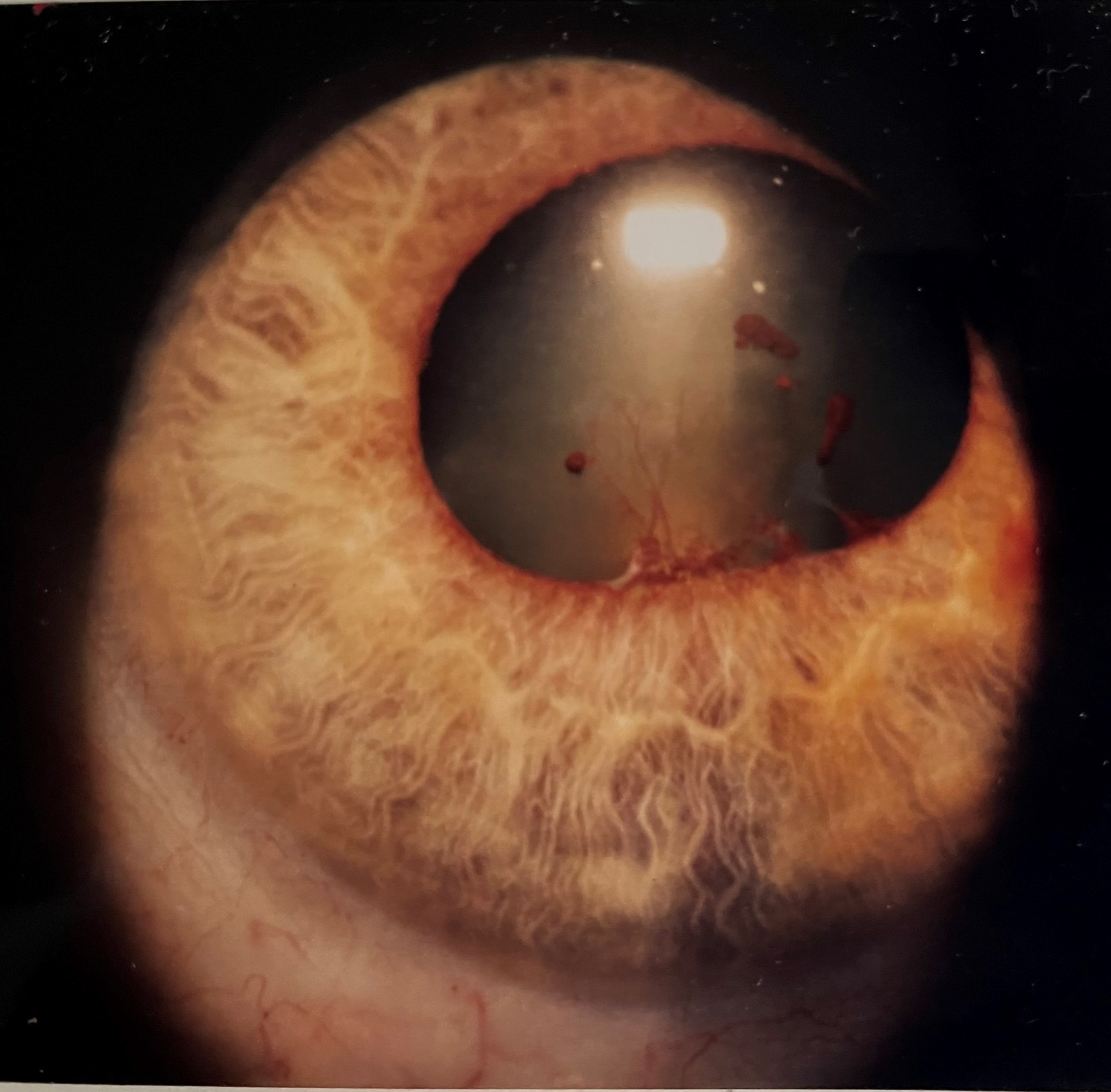 Clinical photograph showing an irregular pupil caused by posterior synechiae between the inflamed iris and the lens.