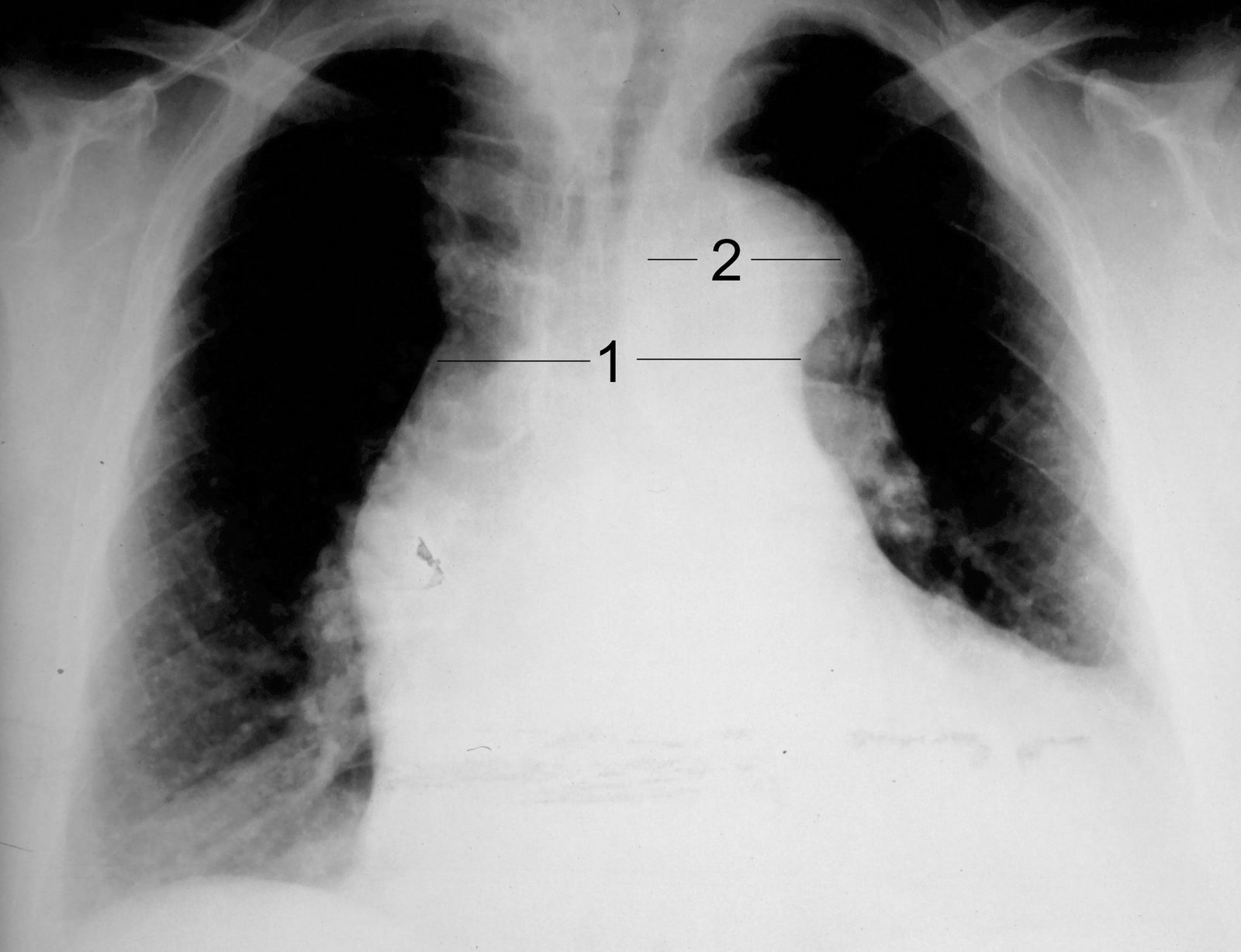 Annotated frontal chest radiograph showing widened mediastinal and aortic contours as a possible clue to thoracic aortic disease, with a warning that a normal film does not exclude dissection.