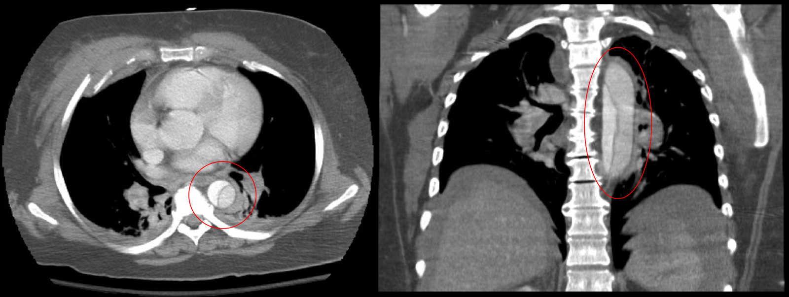 Axial and coronal contrast CT images showing an intimal flap dividing the descending thoracic aorta into true and false lumens in a Stanford type B dissection.