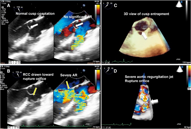 Transoesophageal echocardiography showing a large diastolic regurgitant jet through the aortic valve, with 3D views of the cusp abnormality and regurgitant orifice.