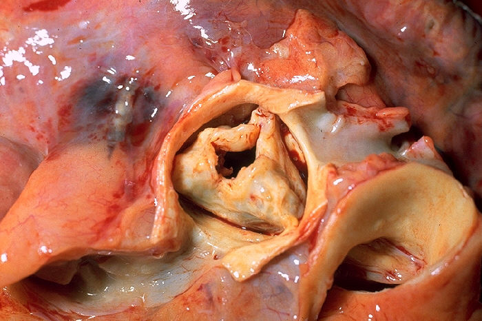 Gross specimen showing thickened, fused rheumatic aortic valve cusps leaving a markedly narrowed central orifice.