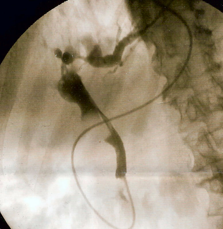 Fluoroscopic ERCP showing cannulation and opacification of the biliary tree with a distal common bile duct filling defect caused by an obstructing stone.