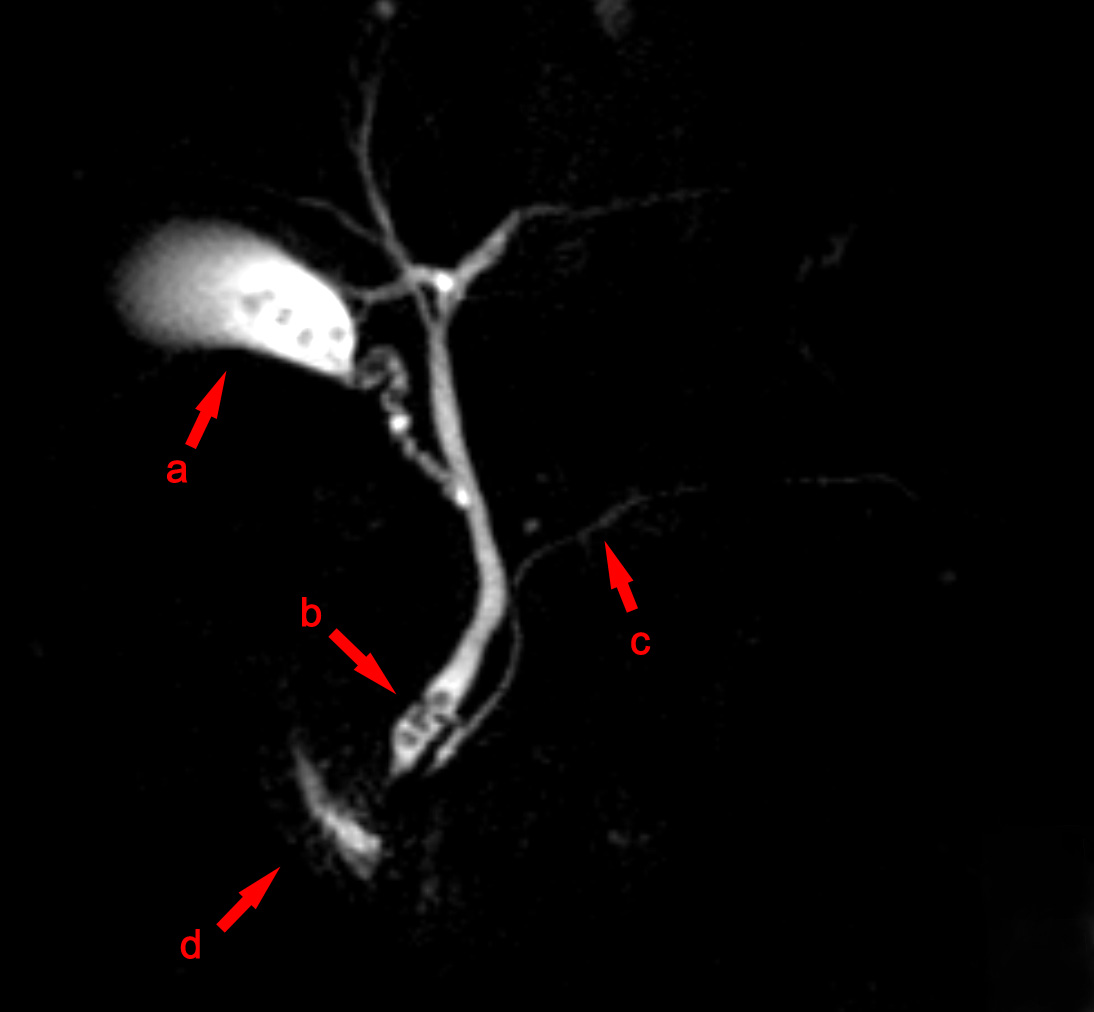 MRCP demonstrating gallstones and dark filling defects within the distal common bile duct, consistent with choledocholithiasis.