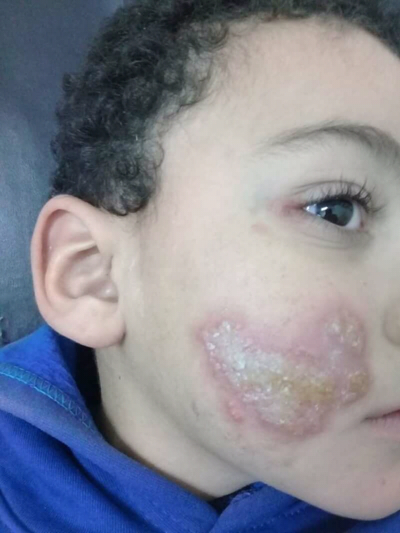 Clinical photograph showing grouped monomorphic vesicles and shallow erosions on eczematous facial skin, a red-flag presentation of eczema herpeticum.