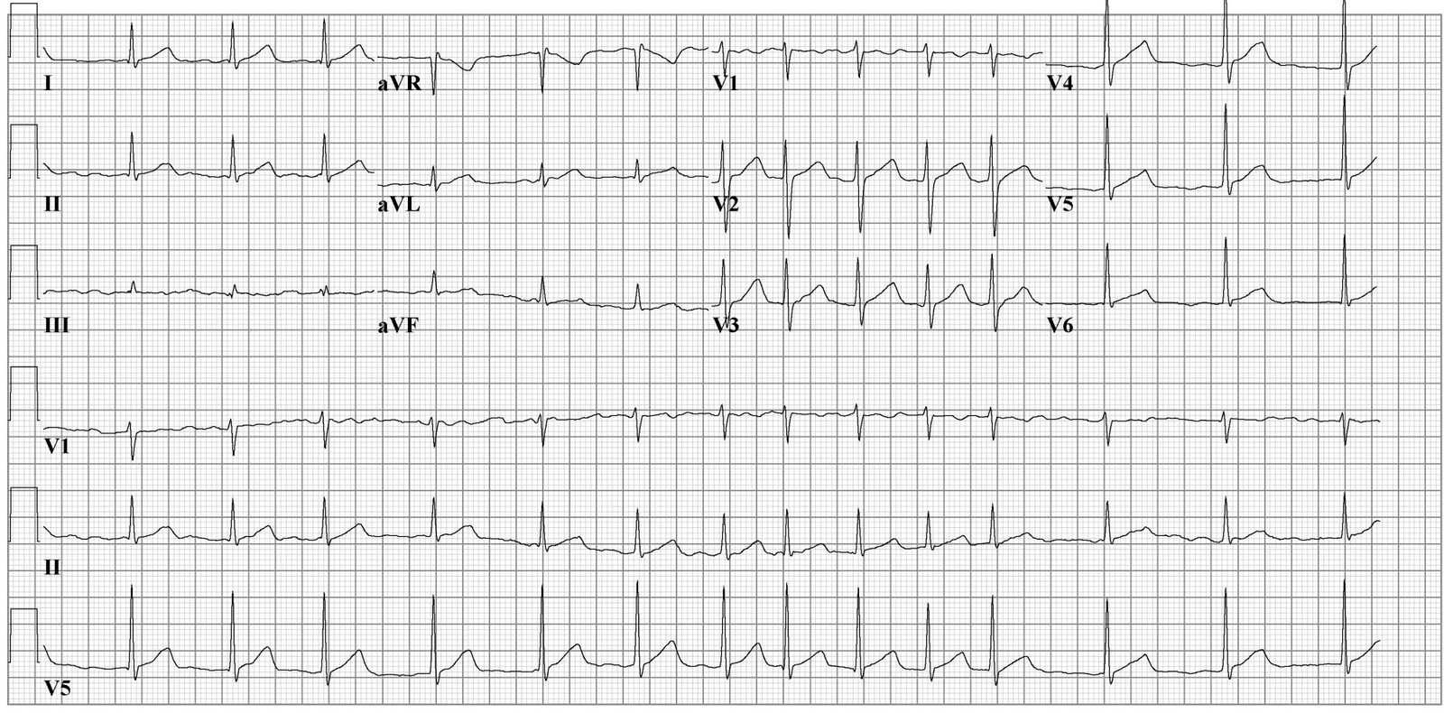 12-lead ECG showing irregular RR intervals and no consistent P waves. A broad or varying QRS morphology should prompt assessment for aberrancy, bundle branch block or pre-excitation rather than being assumed to be uncomplicated AF.