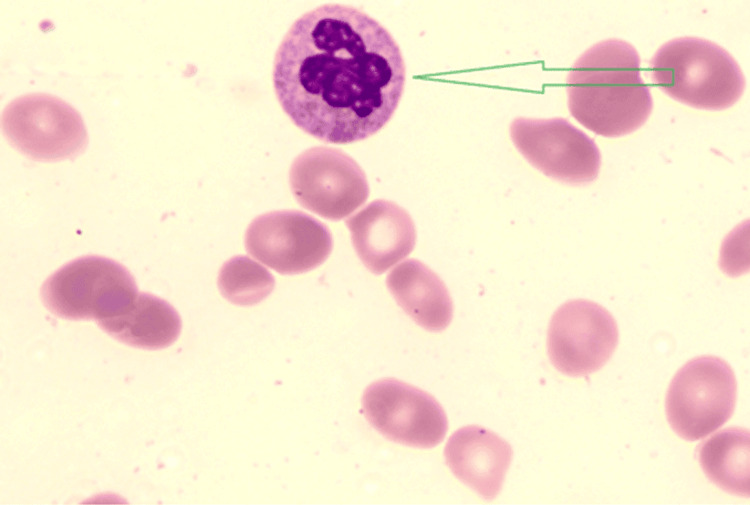 Peripheral blood film showing macro-ovalocytes and a hypersegmented neutrophil, typical of vitamin B12 or folate deficiency.