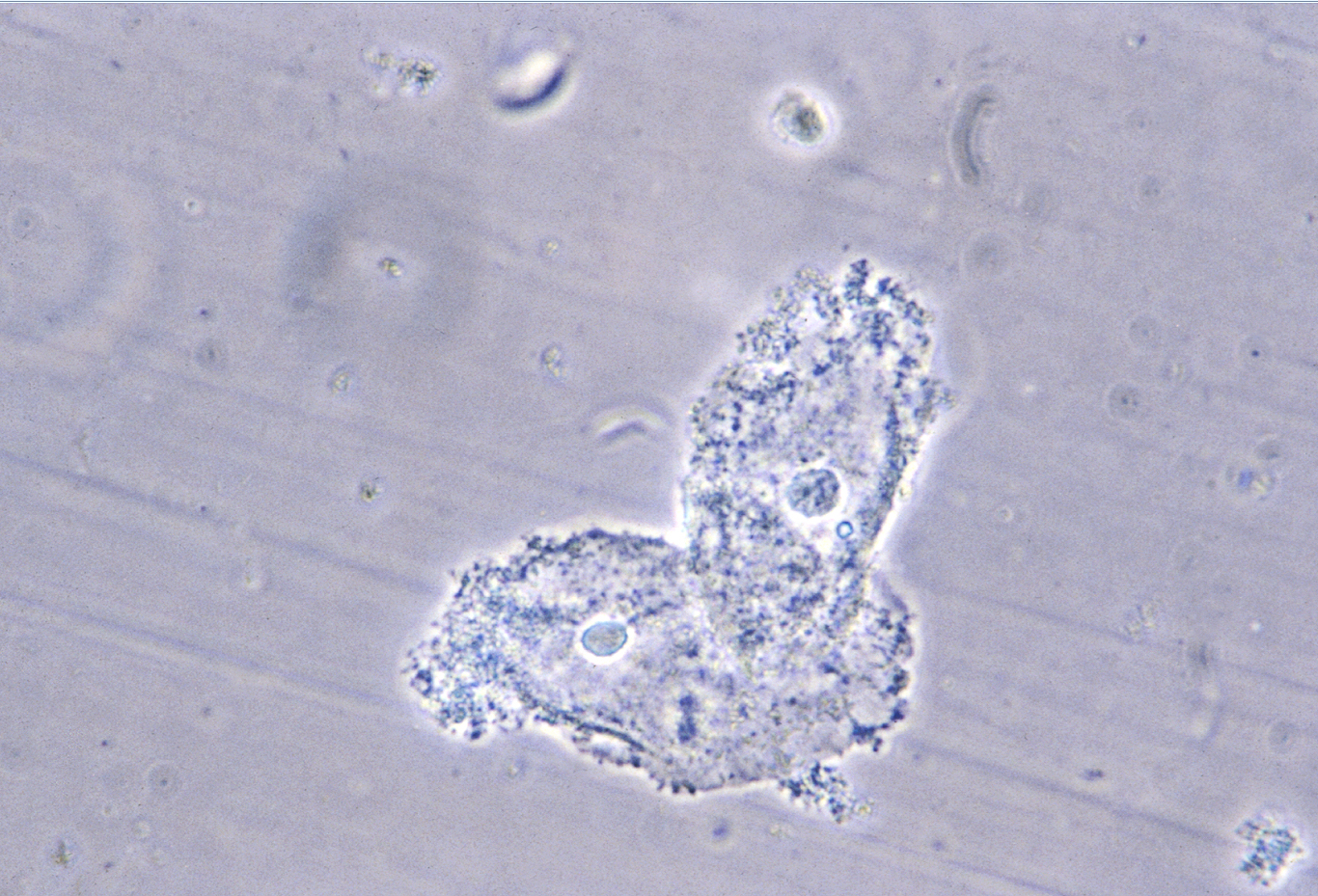 A microscopy image of a vaginal smear showing clue cells, epithelial cells with a granular stippled border from adherent coccobacilli, with relatively few lactobacilli.