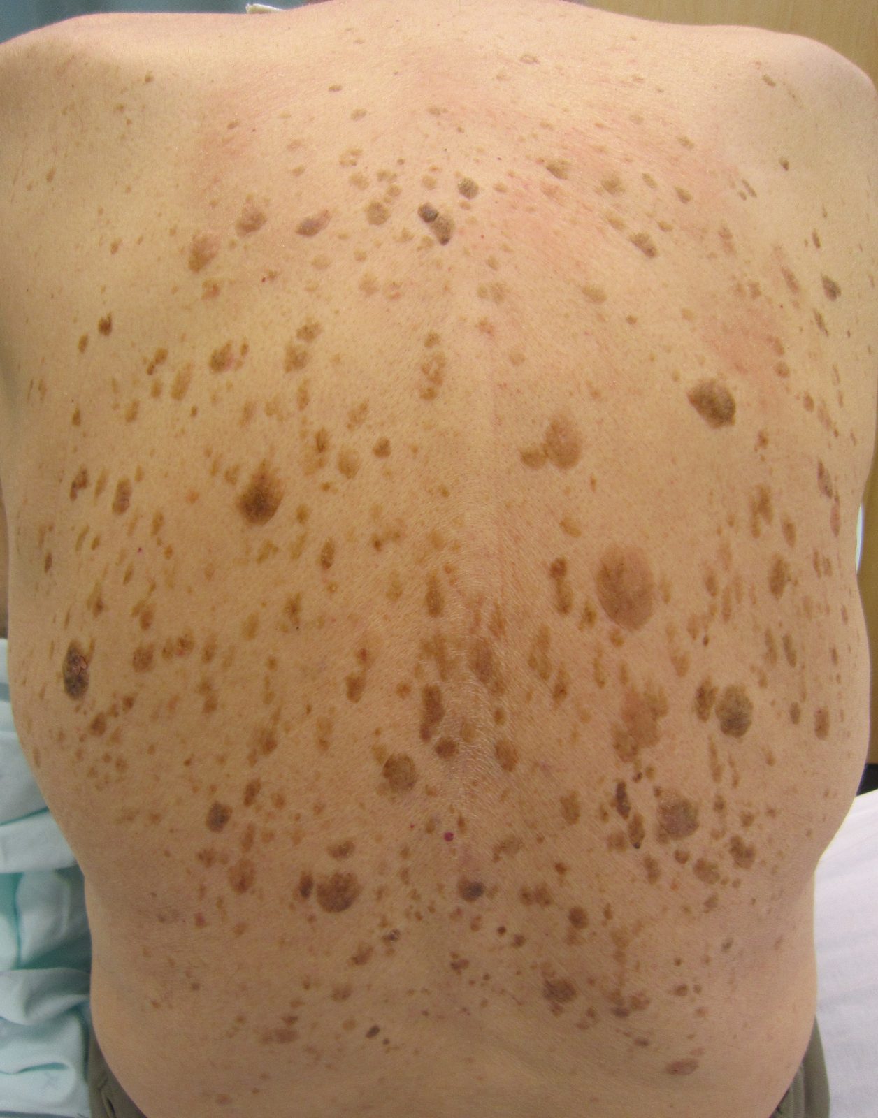 A clinical photograph showing sharply demarcated, brown, waxy or verrucous lesions with a stuck-on appearance, with a legend warning that atypical or changing lesions still require assessment.