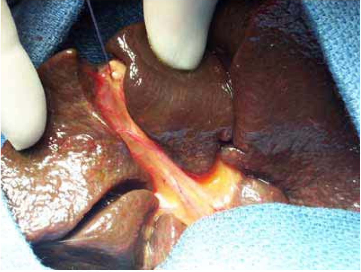 A sourced operative image illustrating extrahepatic biliary atresia; retain attribution and licence information and keep image-quality remediation in the separate image campaign.