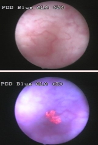 Cystoscopy image showing a papillary urothelial tumour on the bladder mucosa.