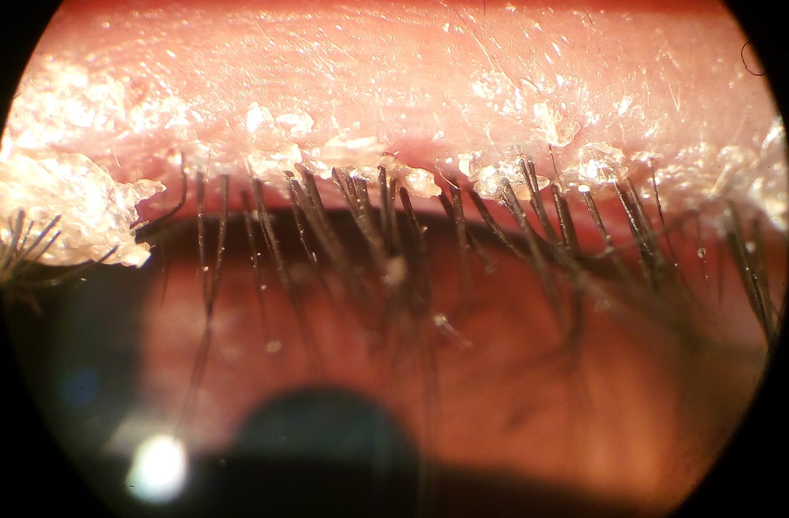 A photograph of an inflamed anterior lid margin with crusting and collarettes around the lash bases. Label it as an illustrative clinical image, not a diagnostic substitute.